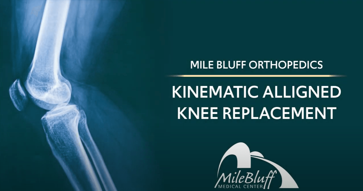 Kinematic Aligned Knee Replacement Mile Bluff Medical Center